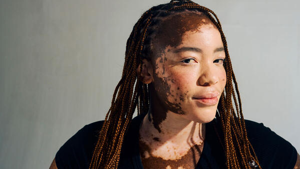 Young woman with vitiligo, autoimmune depigmenting skin disorder