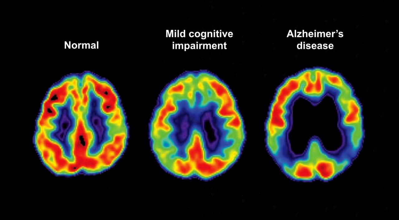 Alzheimer diagnostic