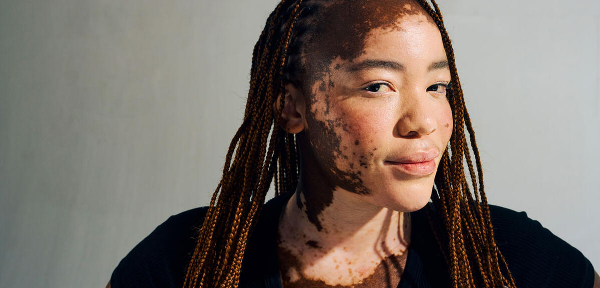 Young woman with vitiligo, autoimmune depigmenting skin disorder