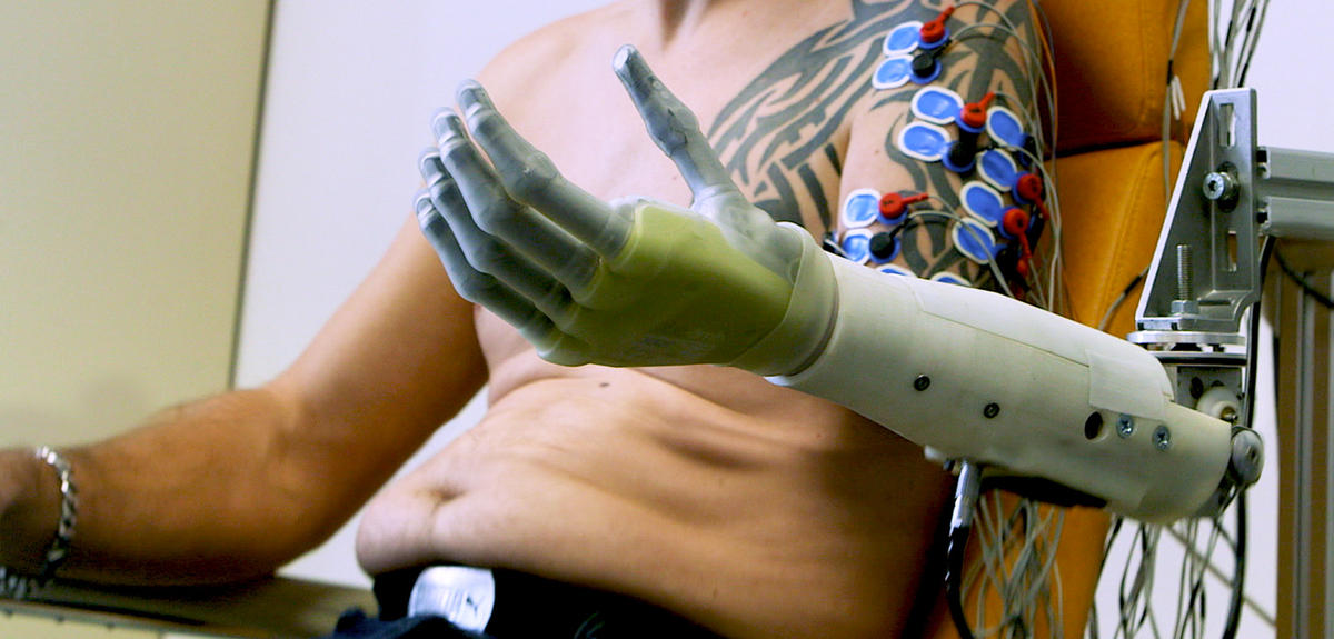 Robotic prosthetic connected to an arm via wires.